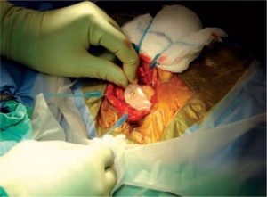 it is a implant-surgery